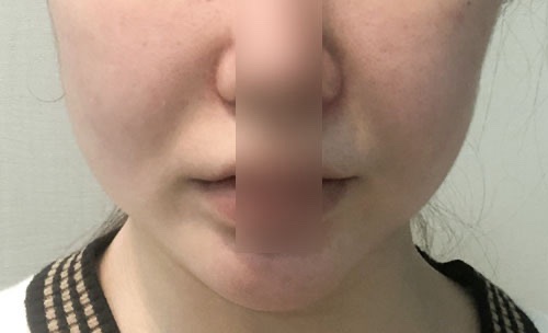 실리프팅 후기