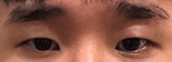 쌍꺼풀(절개) 후기