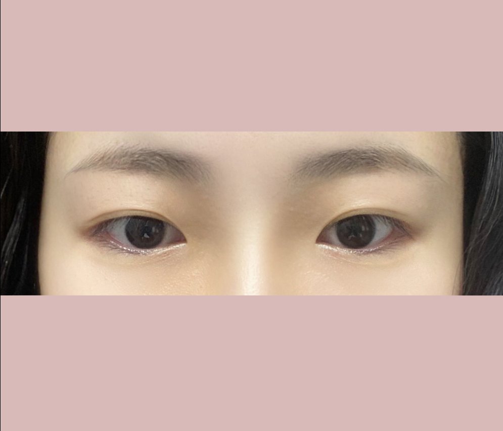 눈매교정 후기