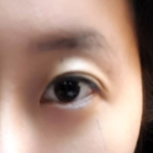 쌍꺼풀(절개) 후기