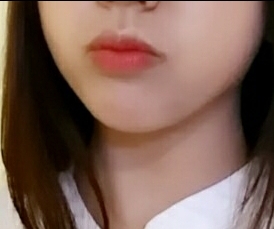 입꼬리성형 후기