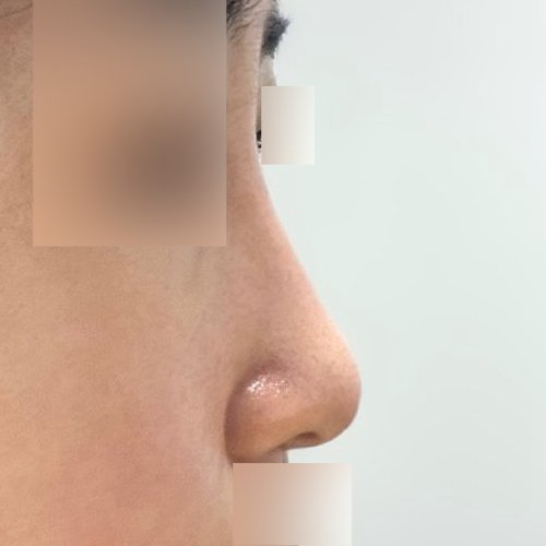 코끝(기증연골) 후기