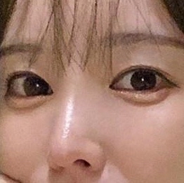 눈재수술 후기