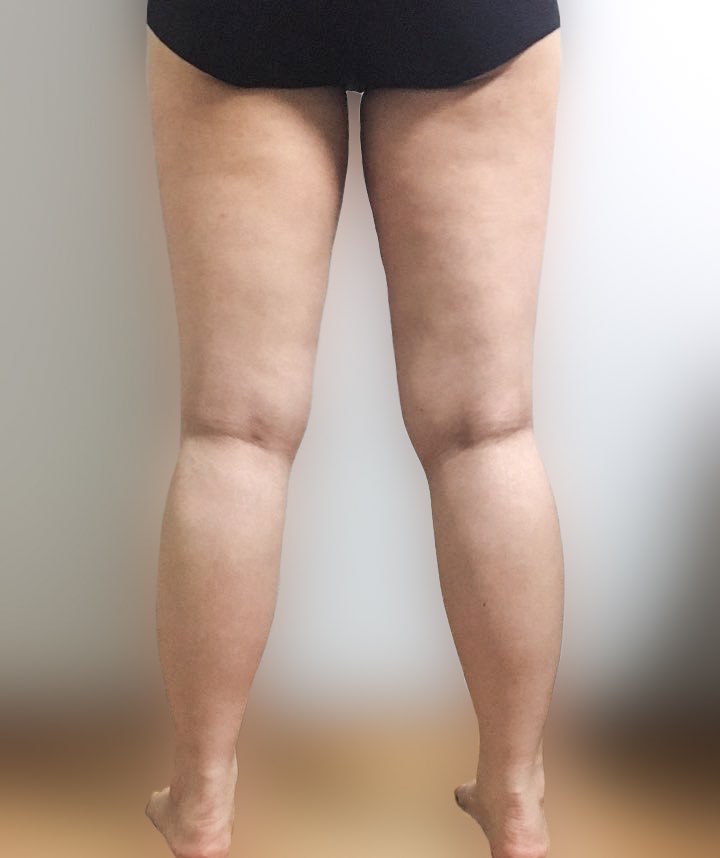 허벅지지방흡입 후기