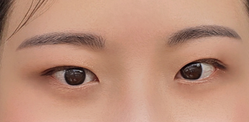 눈재수술 후기