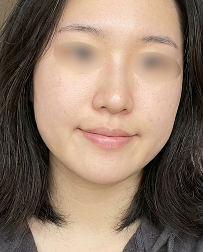 온다리프팅 후기
