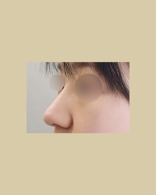 코재수술 후기