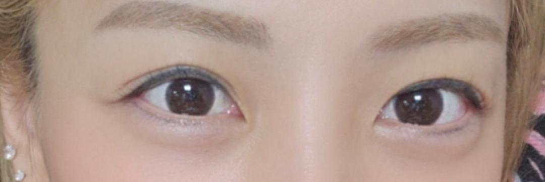 눈재수술 후기