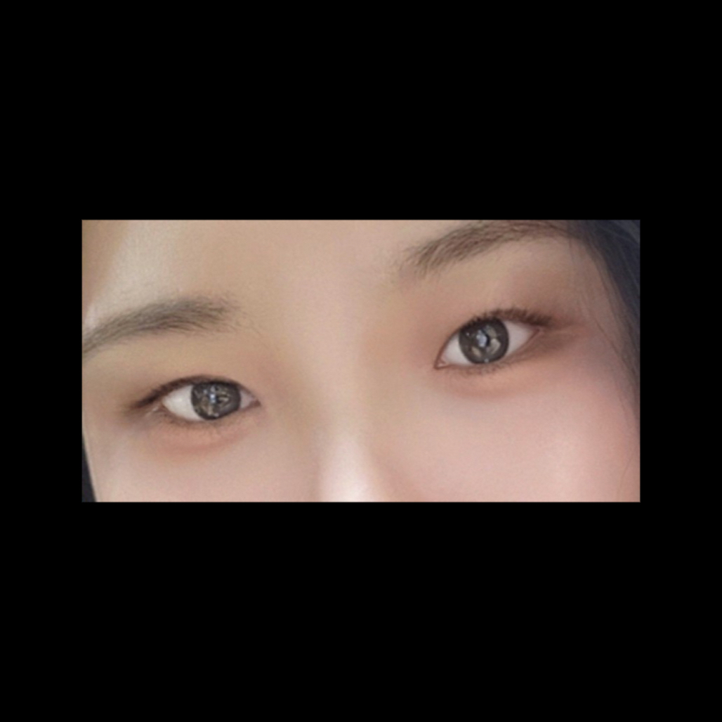 쌍꺼풀(절개) 후기