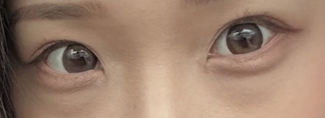 눈재수술 후기