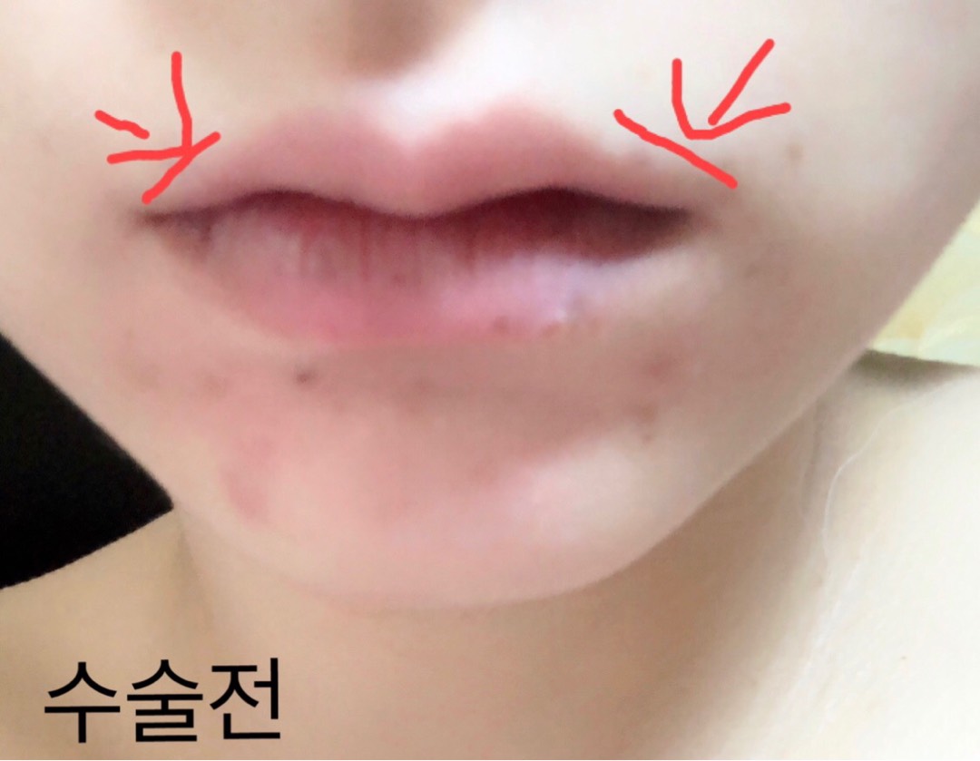 보조개성형 후기