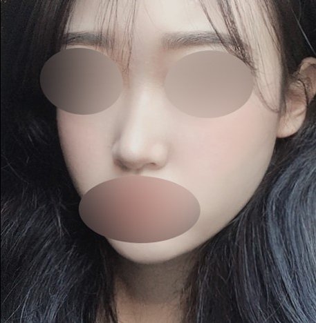 콧대(보형물) 후기