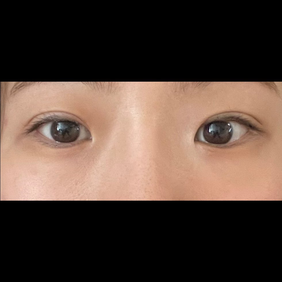 앞트임 후기