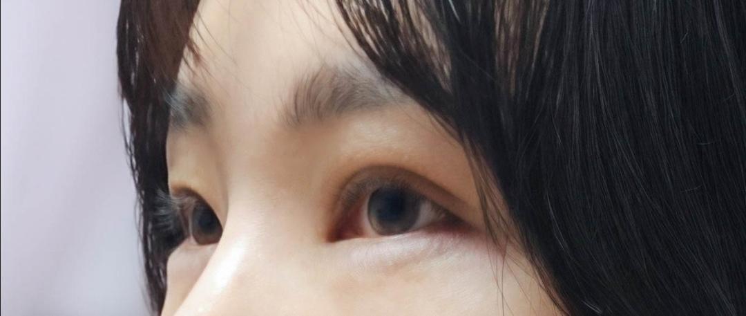 밑트임 후기