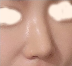 코재수술 후기