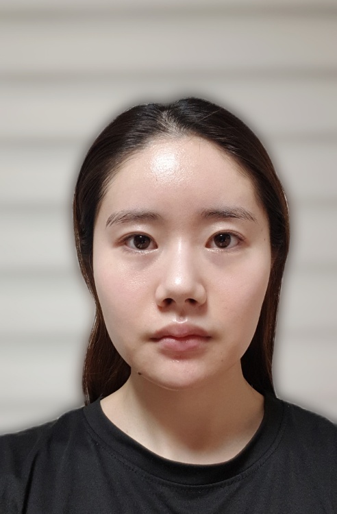 눈재수술 후기