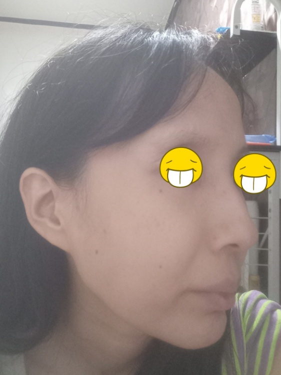 콧대(보형물) 후기