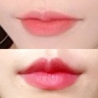 입꼬리성형 후기