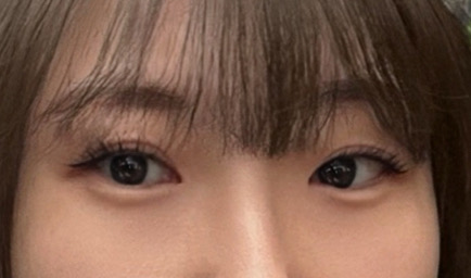 눈재수술 후기