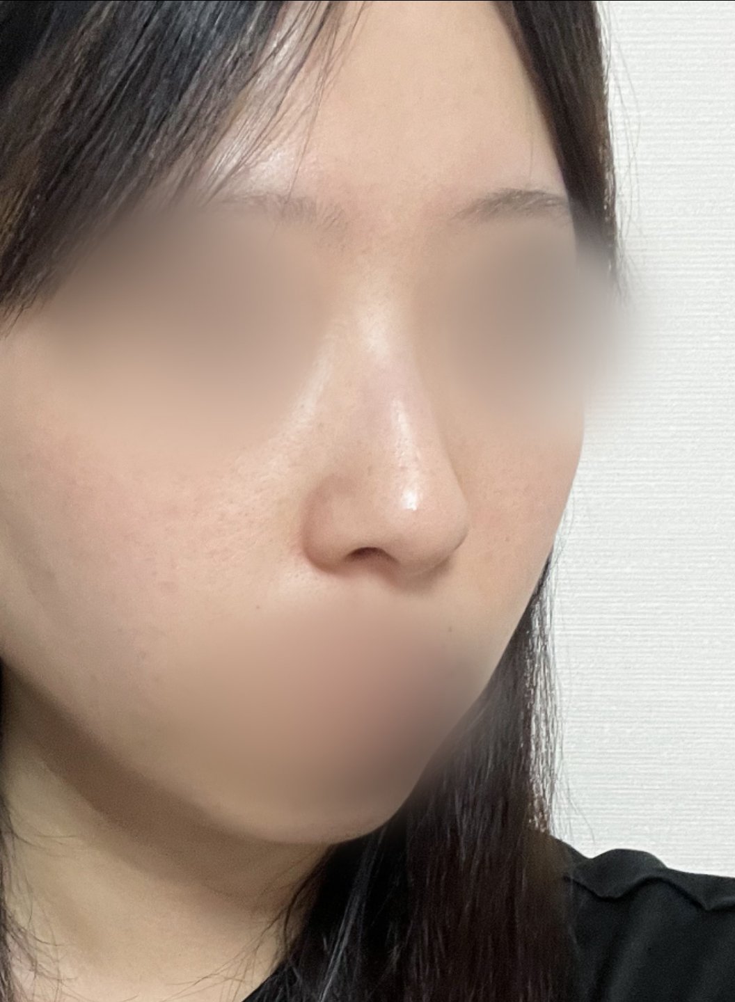 콧대(보형물) 후기