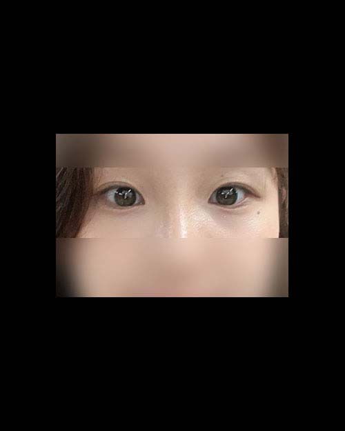 밑트임 후기