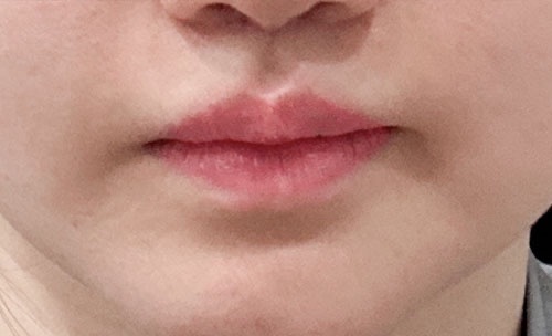 입꼬리성형 후기