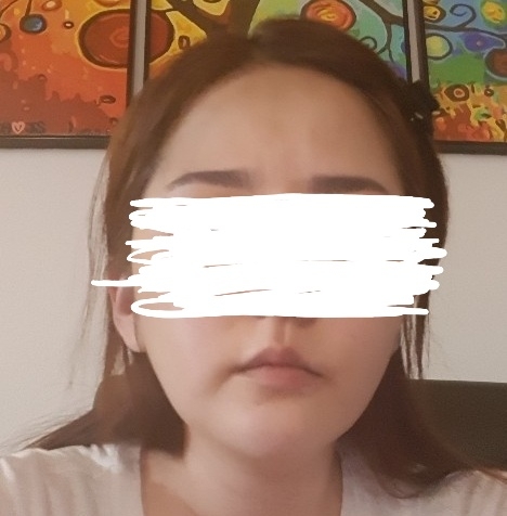 입꼬리성형 후기