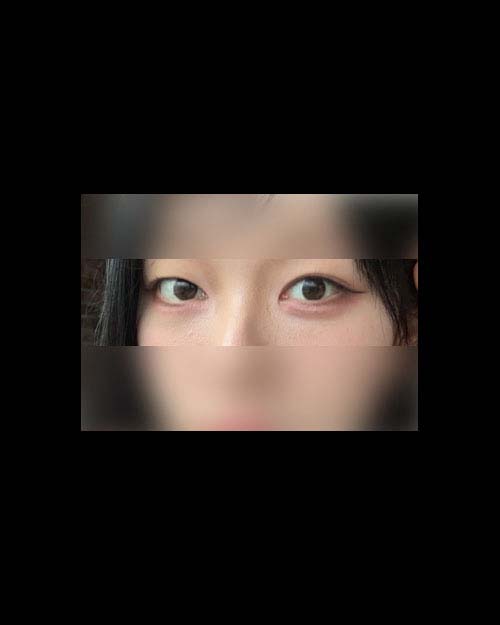 눈재수술 후기