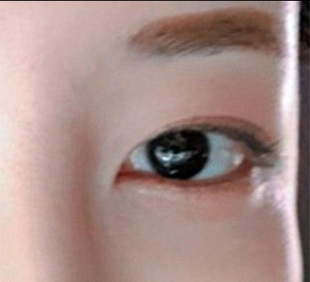 눈재수술 후기