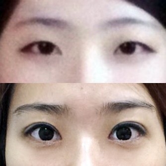 쌍꺼풀(절개) 후기