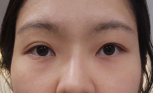 밑트임 후기