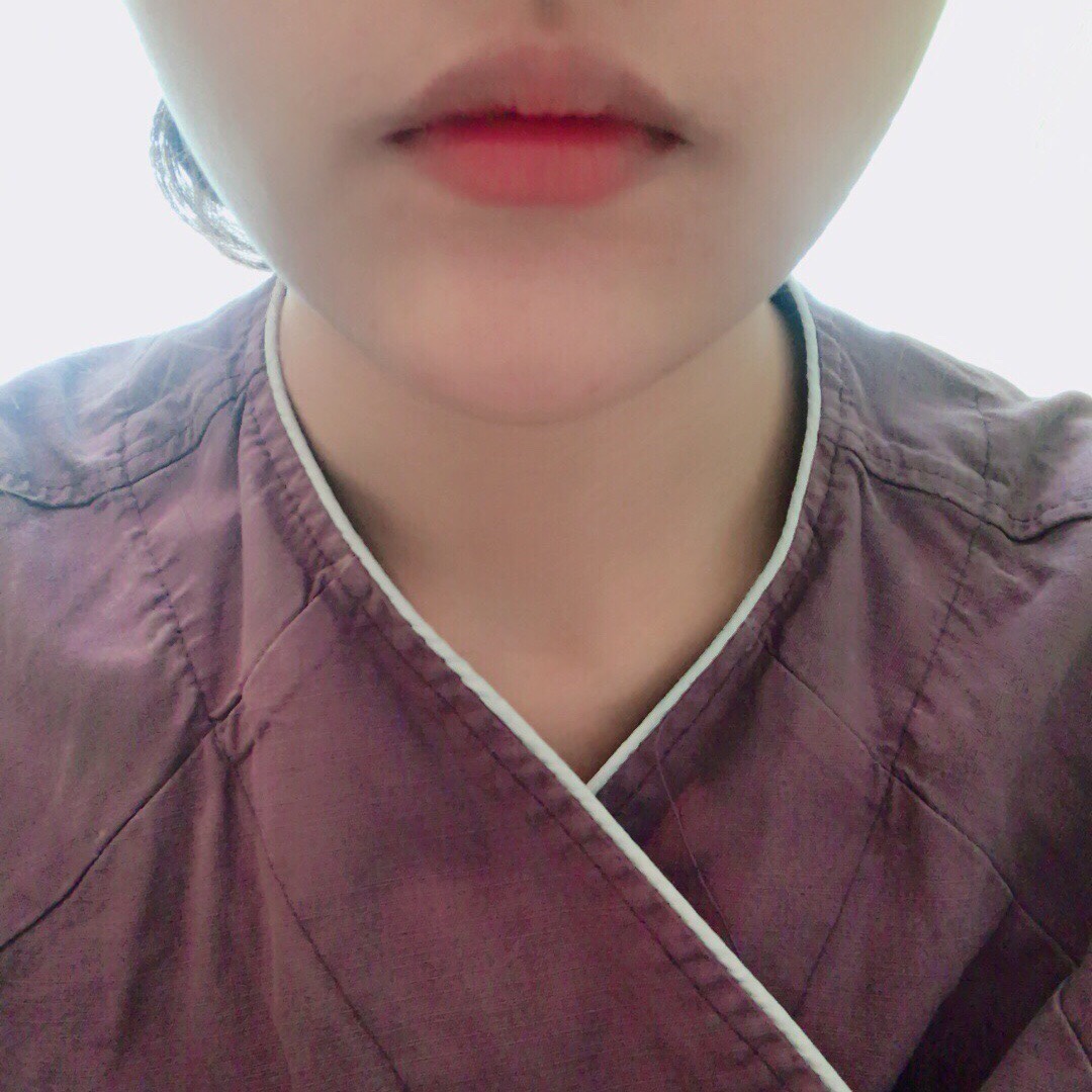 입꼬리성형 후기