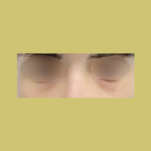 눈밑지방재배치 후기