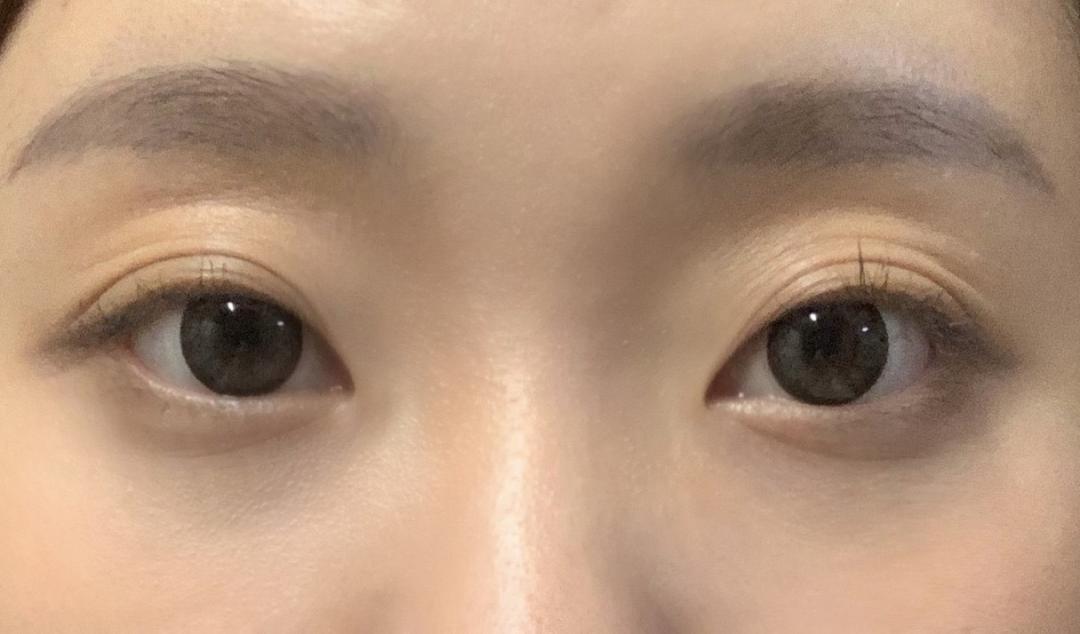 눈재수술 후기