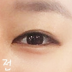 눈재수술 후기