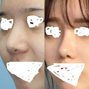 코재수술 후기
