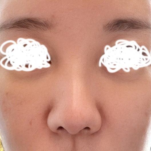 코재수술 후기