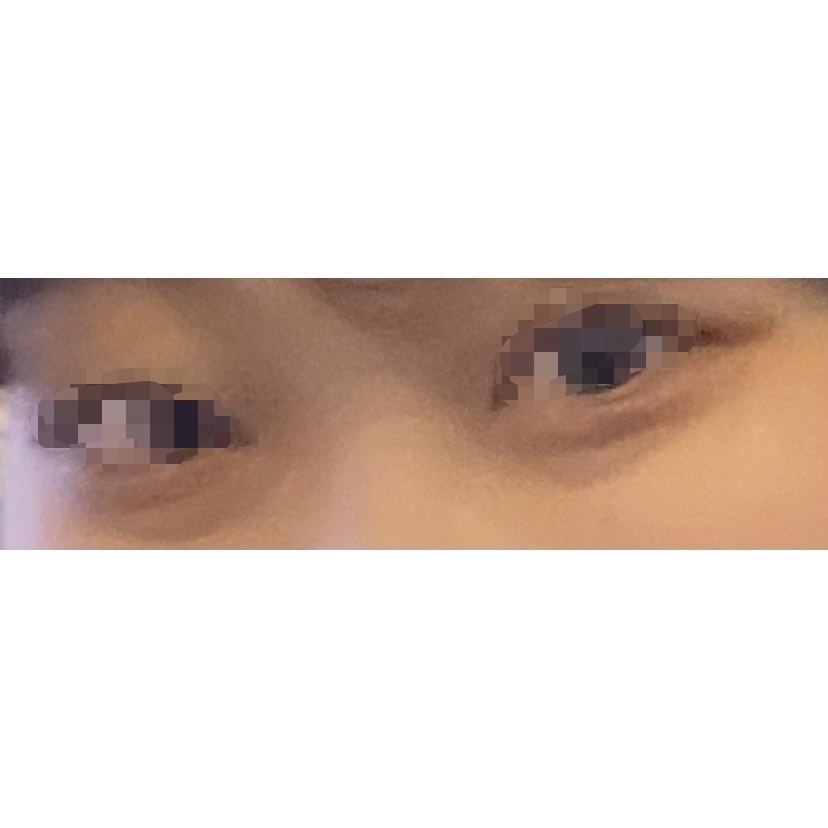 눈밑지방재배치 후기