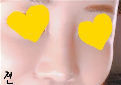 콧볼축소 후기