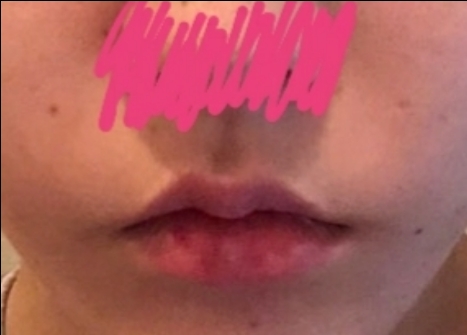 입꼬리성형 후기
