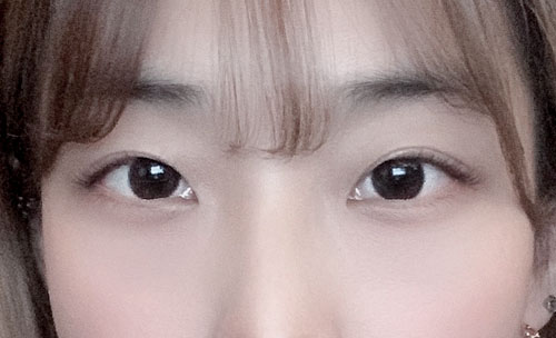 눈재수술 후기
