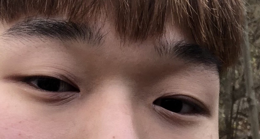 쌍꺼풀(절개) 후기