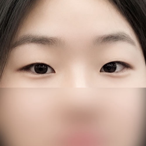 쌍꺼풀(자연유착) 후기