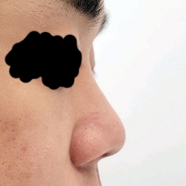 콧대(보형물) 후기