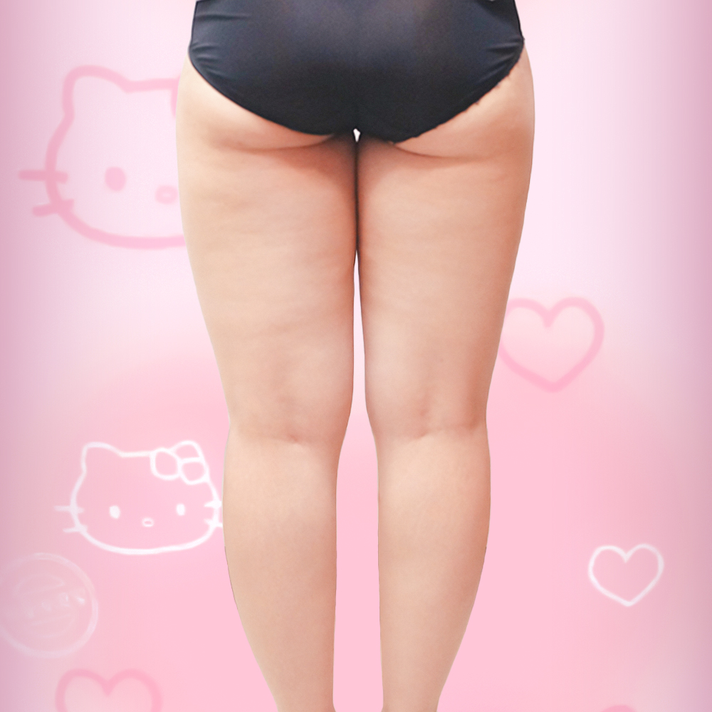 허벅지지방흡입 후기