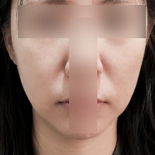 실리프팅 후기