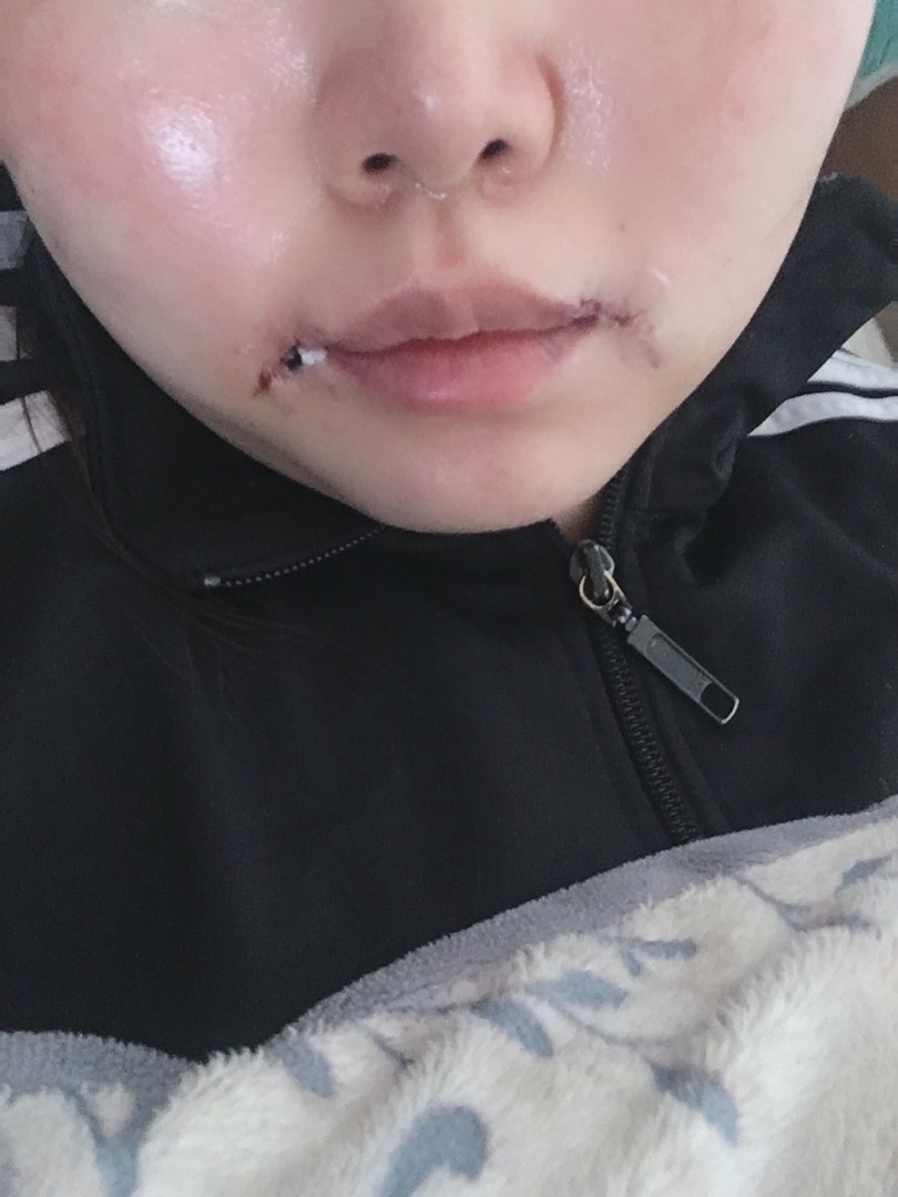 입꼬리성형 후기