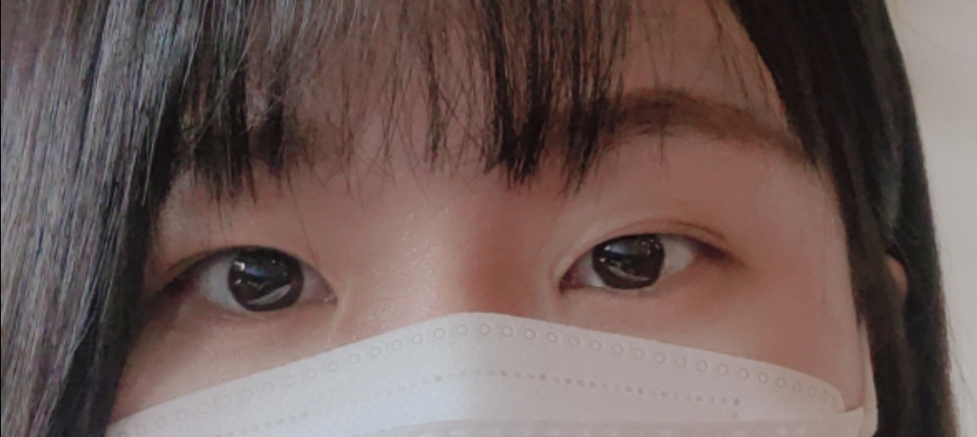 쌍꺼풀(절개) 후기
