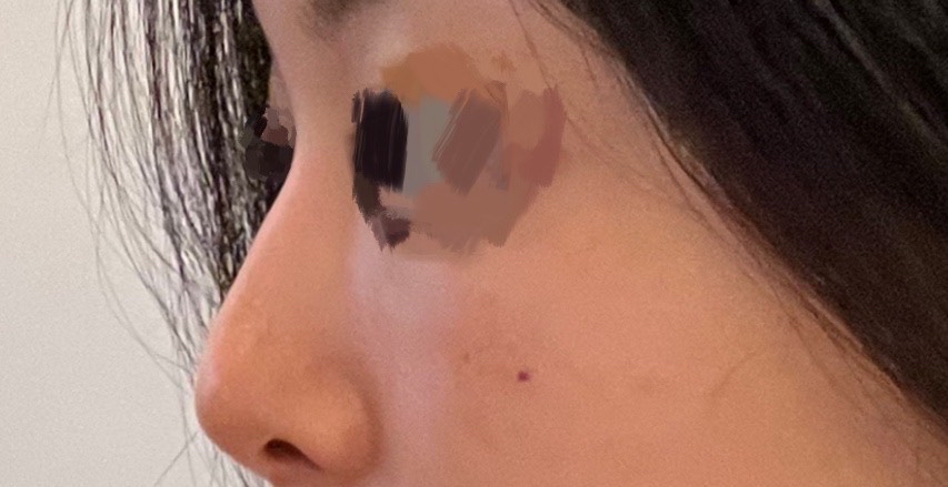 코재수술 후기