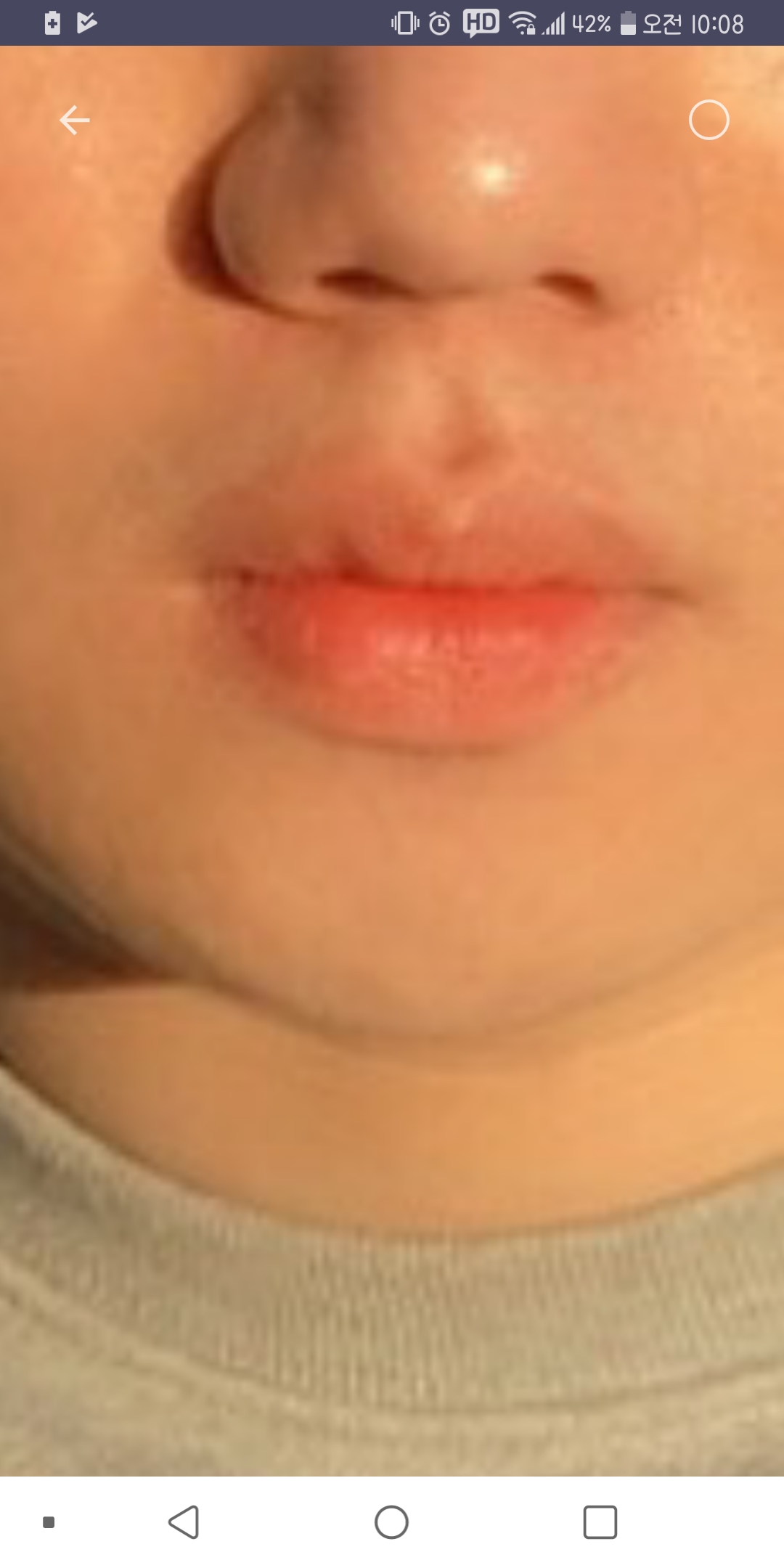 입꼬리성형 후기